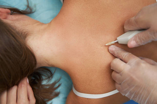 SKIN TAG REMOVAL